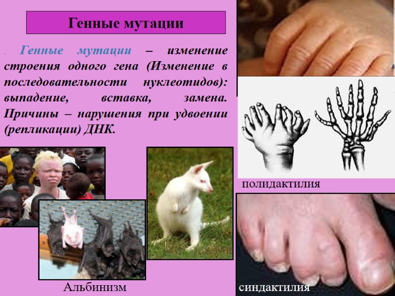 Генные мутации синдактилия полидактилия Альбинизм . Генные мутации – изменение строения одного гена (Изменение